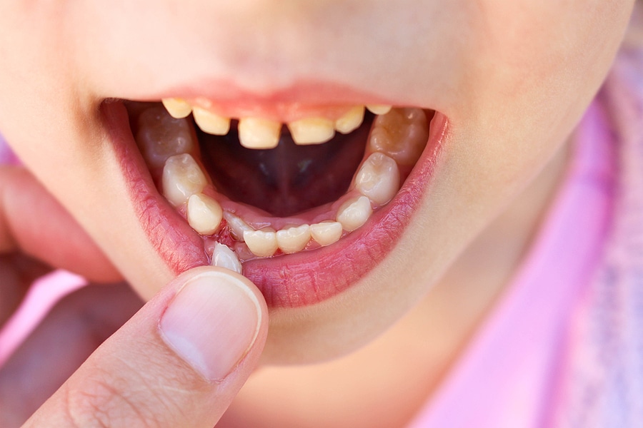 Strategies for Pulling a Loose Tooth the Right Way