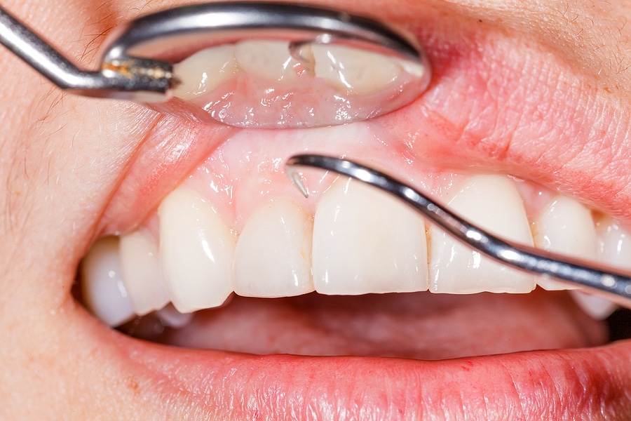 The Early Signs of Gum Disease to Be Aware of