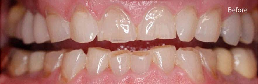 Before Cosmetic Dentistry